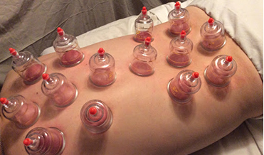 Fire Cupping Therapy
